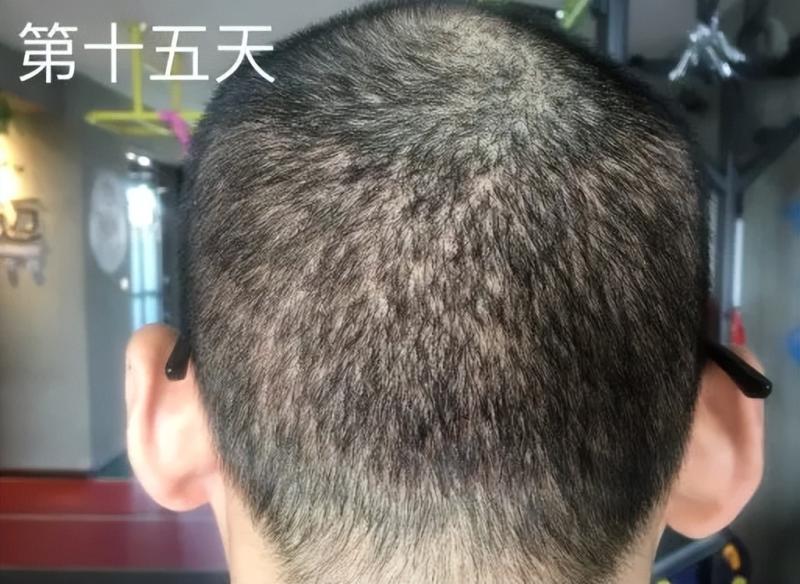 真實案例:植發(fā)效果到底怎么樣?